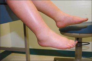 Ways to Reduce Feet Swelling During Pregnancy