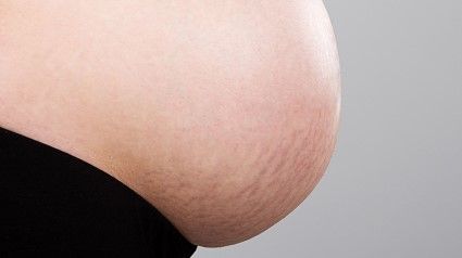 Stretch Marks/ whattoexpect