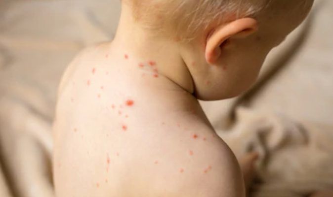 Chicken Pox